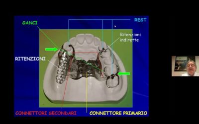 VIDEO: La protesi parziale ad appoggio muco-dentale