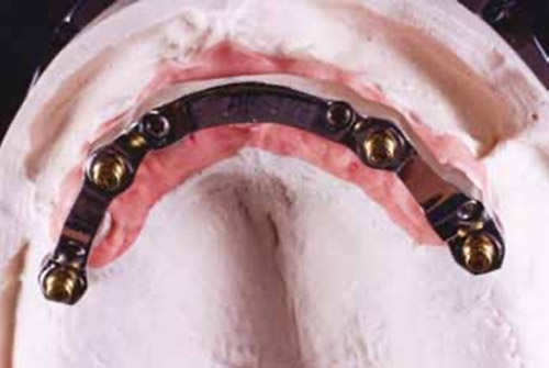 Protocollo odontotecnico semplificato per la realizzazione di una protesi removibile a supporto implantare / mucoso