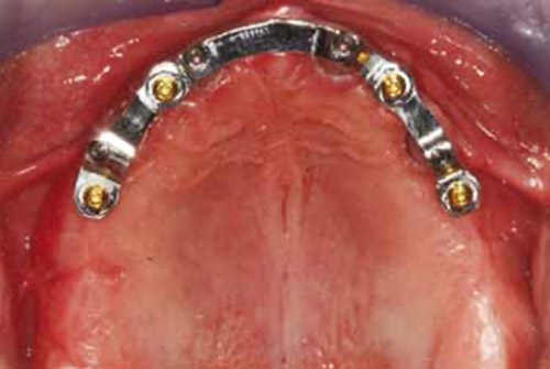 Упрощенный стоматологический протокол для изготовления съемного протеза с опорой на имплант/слизистую