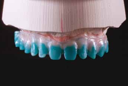 Protocollo odontotecnico semplificato per la realizzazione di una protesi removibile a supporto implantare / mucoso