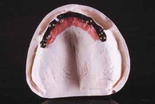 Упрощенный стоматологический протокол для изготовления съемного протеза с опорой на имплант/слизистую